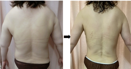 120分コース12回の結果です
注意：効果には個人差がございます。